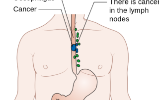 Barrett's esophagus treatment